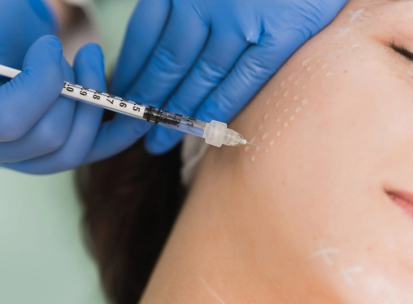 Mesotherapy (Zoom Training)